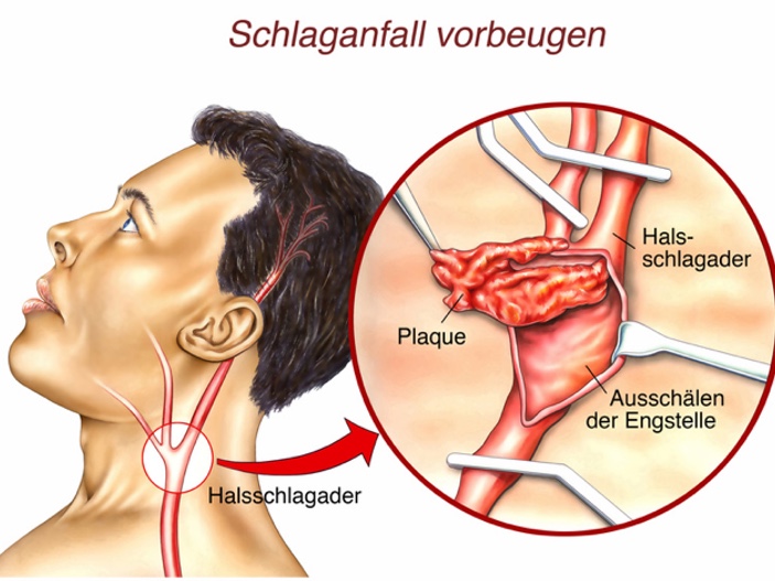 Operation an der Halsschlagader? (Bildquelle: Henrie?Fotolia.com) Operation an der Halsschlagader? (Bildquelle: Henrie?Fotolia.com)