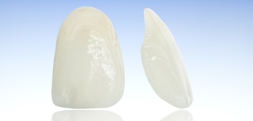 Veneers können bei Zahnverfärbungen eine Lösung sein. (Bildquelle:©sebra?Fotolia.com) Veneers können bei Zahnverfärbungen eine Lösung sein. (Bildquelle:©sebra?Fotolia.com)
