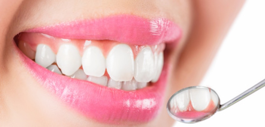 Veneers können bei Zahnverfärbungen helfen. (Bildquelle: jayzynism?Fotolia) Veneers können bei Zahnverfärbungen helfen. (Bildquelle: jayzynism?Fotolia)