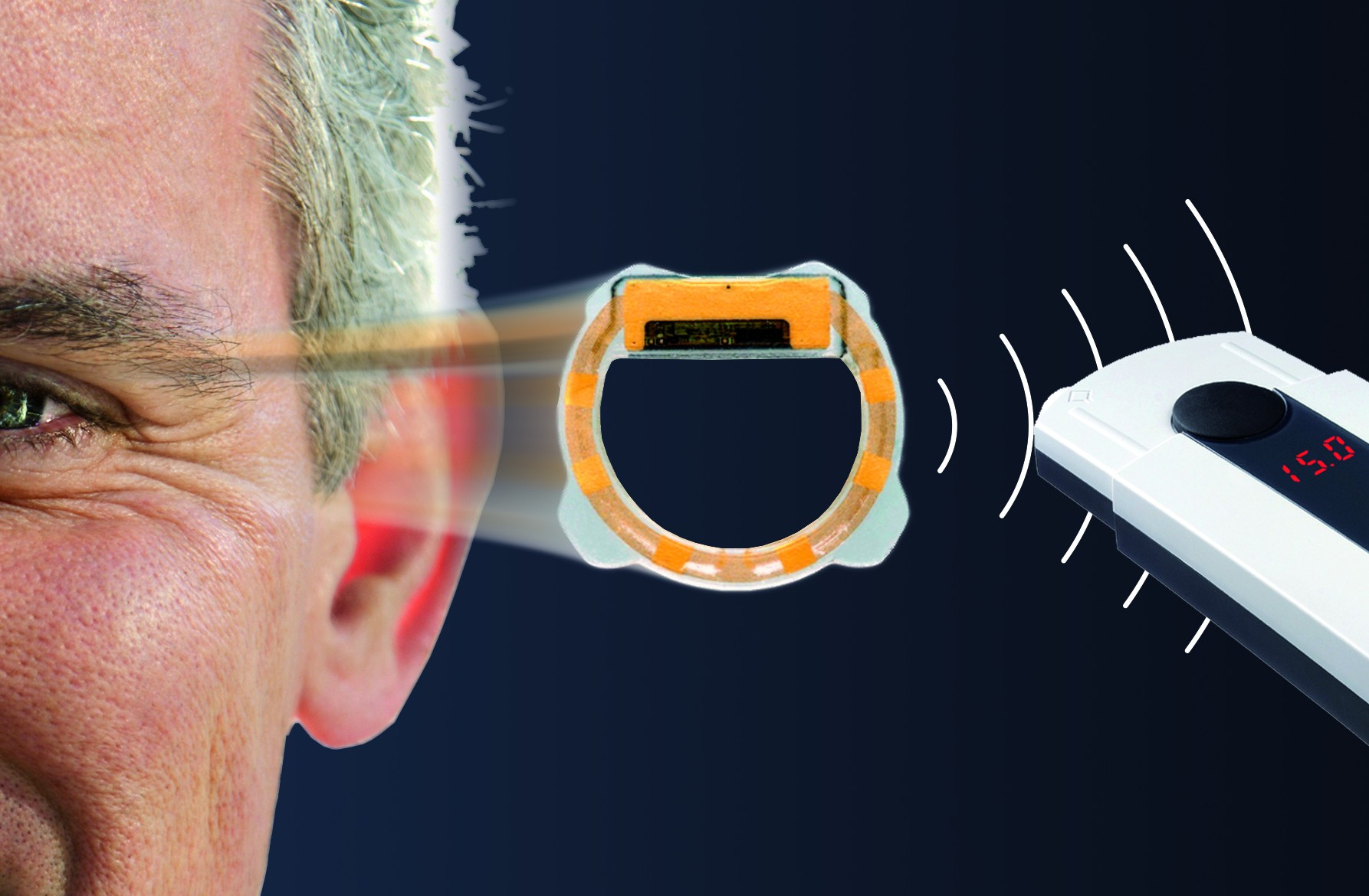 Das EYEMATE(TM)-Implantat misst den Augeninnendruck und ist für den Patienten gut verträglich (Bildq