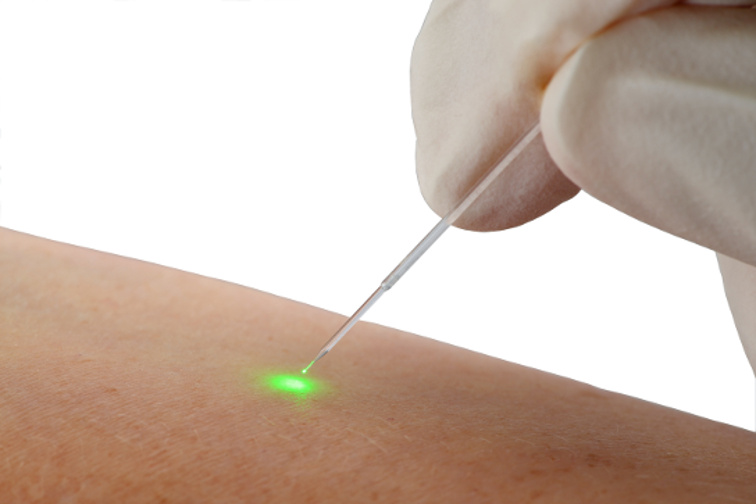 Die neue?Sharp tip?-Laserfaser der biolitec®(Bildquelle: biolitec biomedical technology GmbH) Die neue?Sharp tip?-Laserfaser der biolitec®(Bildquelle: biolitec biomedical technology GmbH)