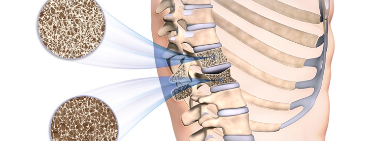 Verschiedene Faktoren können eine Osteoporose begünstigen. (Bildquelle:©Sagittaria?Fotolia)
