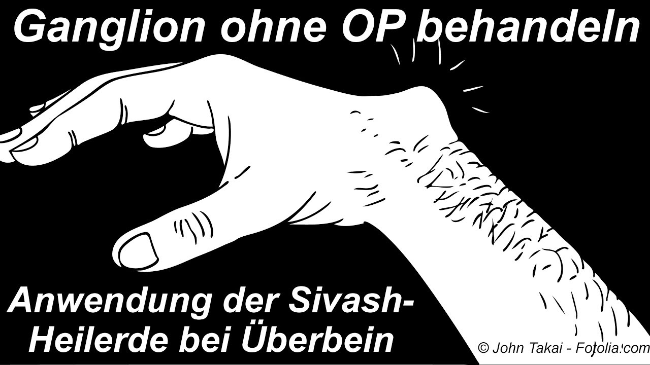 Ganglion ohne Operation behandeln