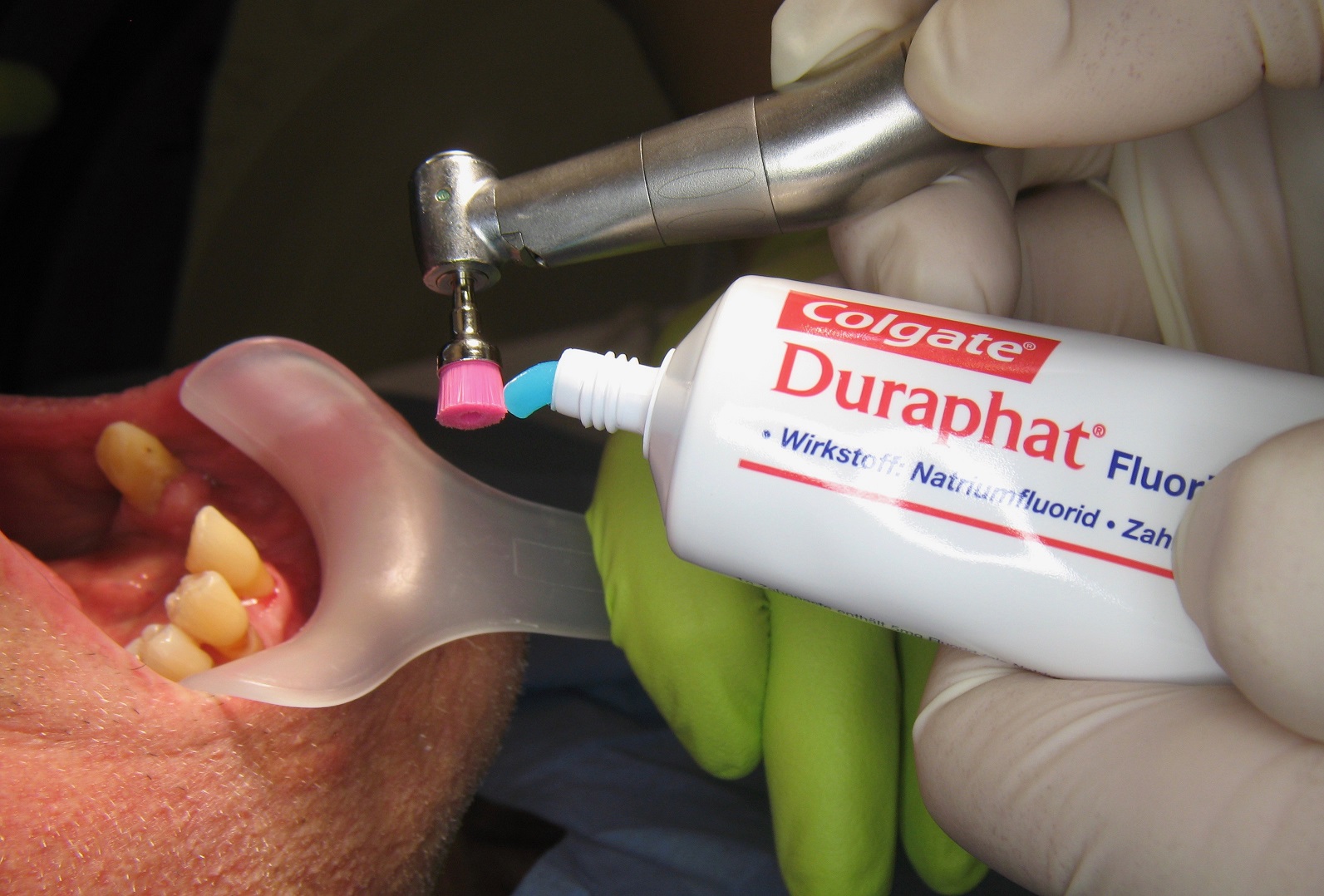 Einsatz der Duraphat®Zahnpaste im Rahmen der UPT (Bildquelle: Dr. Dirk Bleiel) Einsatz der Duraphat®Zahnpaste im Rahmen der UPT (Bildquelle: Dr. Dirk Bleiel)