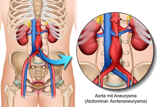 Ein Bauchaortenaneurysma sollte regelmäßig untersucht werden. (Bildquelle:©bilderzwerg?Fotolia) Ein Bauchaortenaneurysma sollte regelmäßig untersucht werden. (Bildquelle:©bilderzwerg?Fotolia)