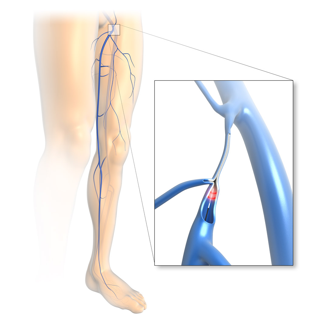 Behandlung einer Krampfader mit der ELVeS®Radial®2ring-Faser von biolitec®(Bildquelle: biolitec biom
