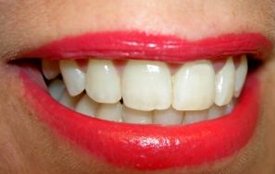 Dentalplus: Perfektes Lächeln ohne Lücke dank Implantat oder Brücke©jdasham123