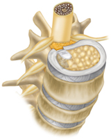 Grafik Implantat von Barricaid® 
