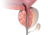 Prostata-Behandlung mit der TWISTER-Faser der biolitec®(Bildquelle: biolitec biomedical technology G Prostata-Behandlung mit der TWISTER-Faser der biolitec®(Bildquelle: biolitec biomedical technology G