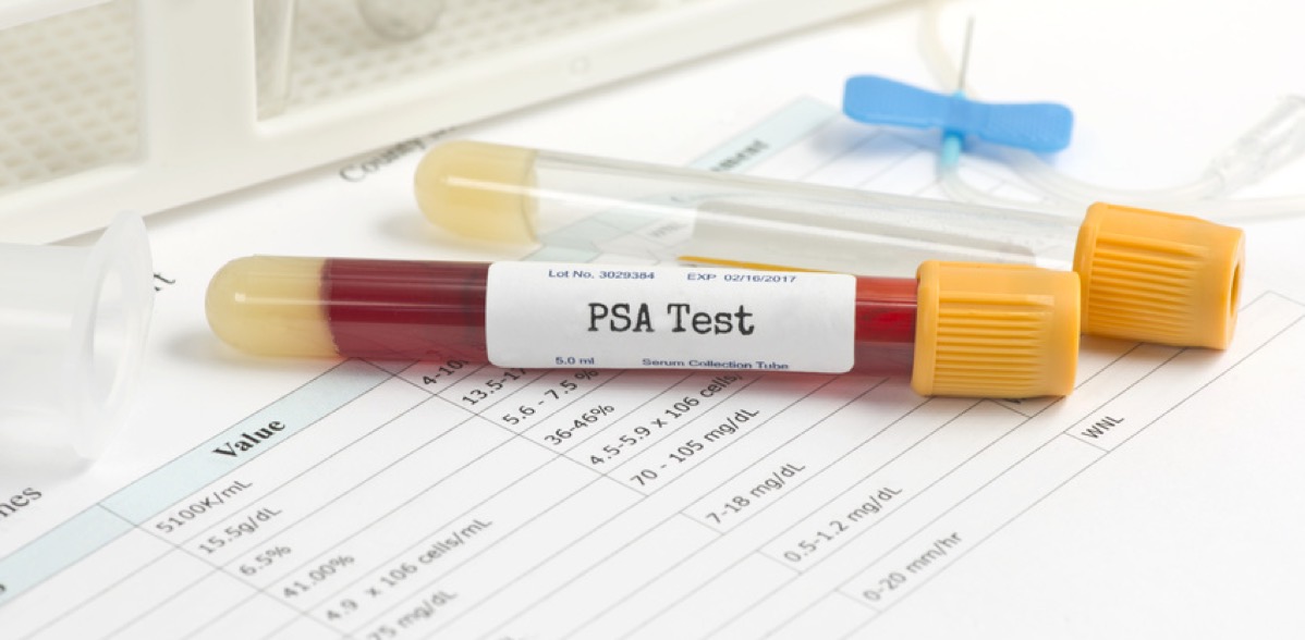 PSA Wert: Was lässt sich hiermit bestimmen? (Bildquelle:©Sherry Young?Fotolia)