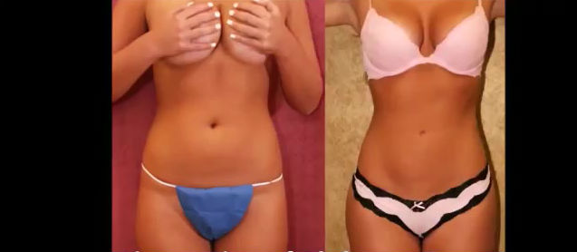 Vor und nach der OP Vor und nach der OP