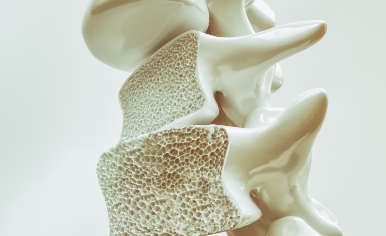 Die Knochendichtemessung gibt Hinweise auf die Stoffwechselkrankheit Osteoporose. (Bildquelle:©crevi