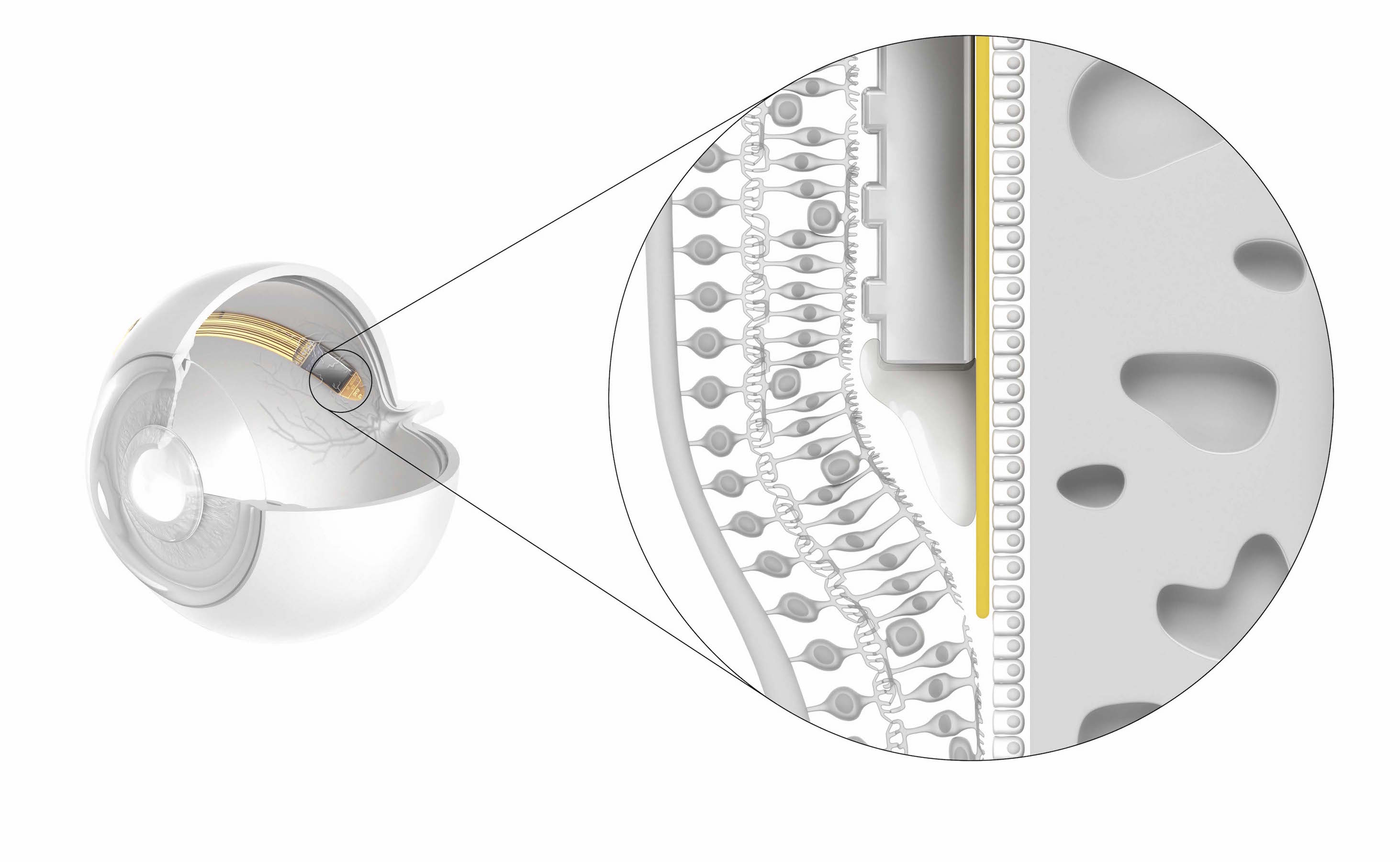 Das Netzhautimplantat RETINA IMPLANT Alpha AMS (Bildquelle: Retina Implant AG)