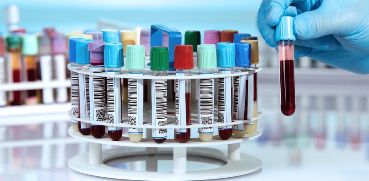 PSA Wert gibt Auskunft zu eventuellen Veränderungen der Prostata. (Bildquelle:©angellodeco - Fotolia