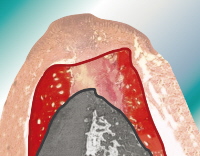 Photomontage des Knochenabbaus nach Extraktion, welcher durch alveoprotect vermindert wird. Photomontage des Knochenabbaus nach Extraktion, welcher durch alveoprotect vermindert wird.