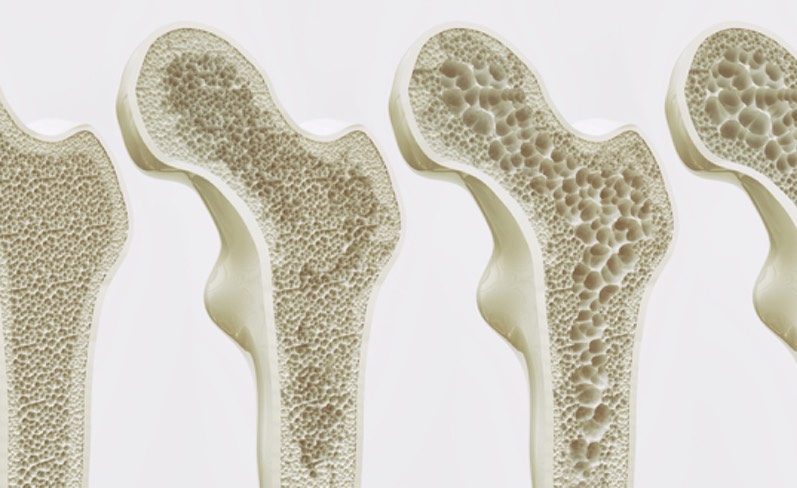 Knochendichtemessung ist ein sinnvolles und sicheres Verfahren. (Bildquelle:©crevis?Fotolia)