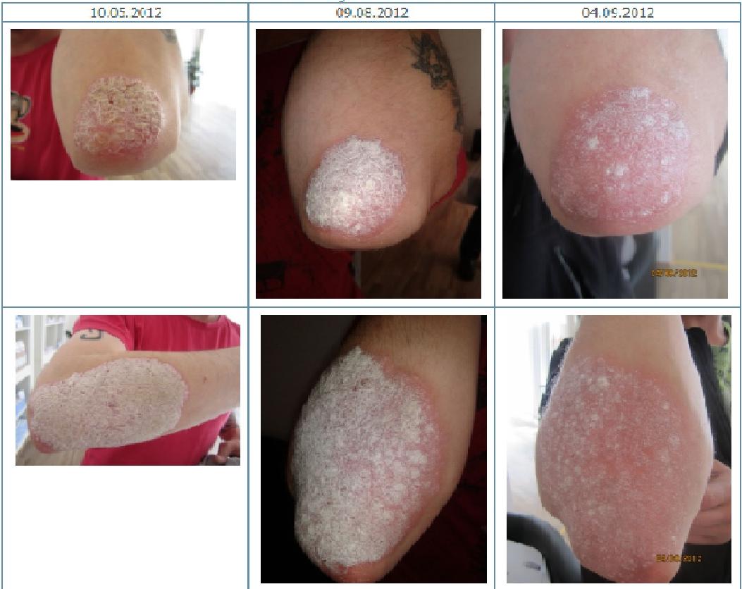 Psoriasis erfolgreich zu Hause behandeln Psoriasis erfolgreich zu Hause behandeln