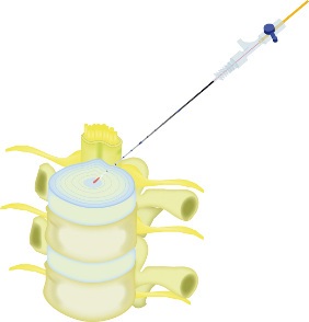 Bandscheiben-Behandlung mit der PLDD-Laserfaser der biolitec®(Bildquelle:©biolitec®) Bandscheiben-Behandlung mit der PLDD-Laserfaser der biolitec®(Bildquelle:©biolitec®)