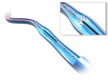 Die neue Laserfaser ELVeS®Radial®2ring Pro während der Behandlung in der Vene (Bildquelle:©biolitec® Die neue Laserfaser ELVeS®Radial®2ring Pro während der Behandlung in der Vene (Bildquelle:©biolitec®