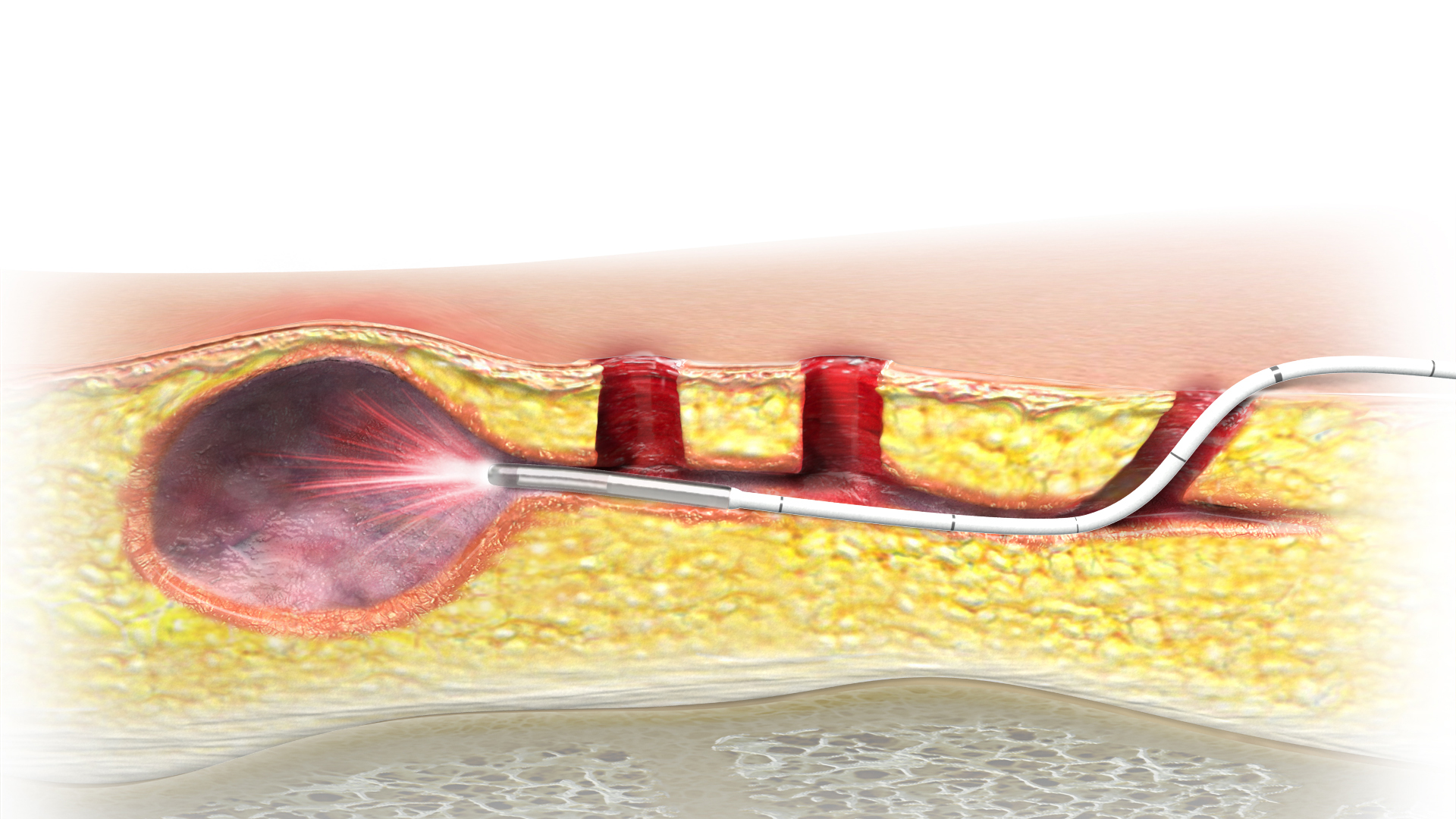 Steißbeinfistelbehandlung mit der SiLaC®-Methode der biolitec®(Bildquelle: @ biolitec) Steißbeinfistelbehandlung mit der SiLaC®-Methode der biolitec®(Bildquelle: @ biolitec)