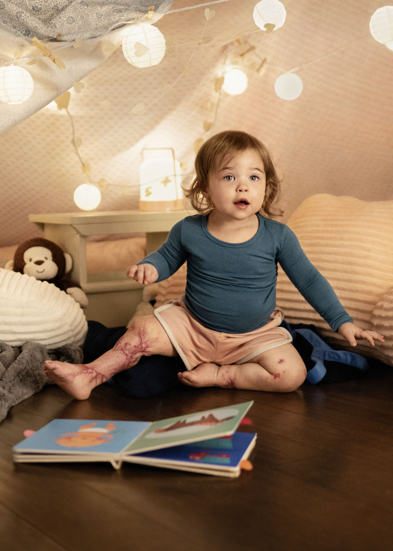 Die kleine Leonie hat eine Meningokokken-Erkankung überlebt Die kleine Leonie hat eine Meningokokken-Erkankung überlebt