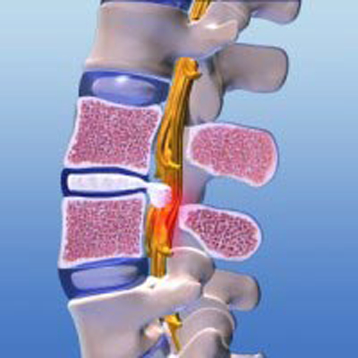 endoskopische Bandscheibenoperation endoskopische Bandscheibenoperation