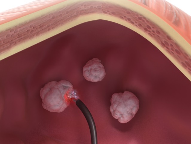 Entfernung nicht-invasiver Blasentumoren mit der TULA®-Lasertherapie der biolitec®(Bildquelle:©biolitec®) Entfernung nicht-invasiver Blasentumoren mit der TULA®-Lasertherapie der biolitec®(Bildquelle:©biolitec®)