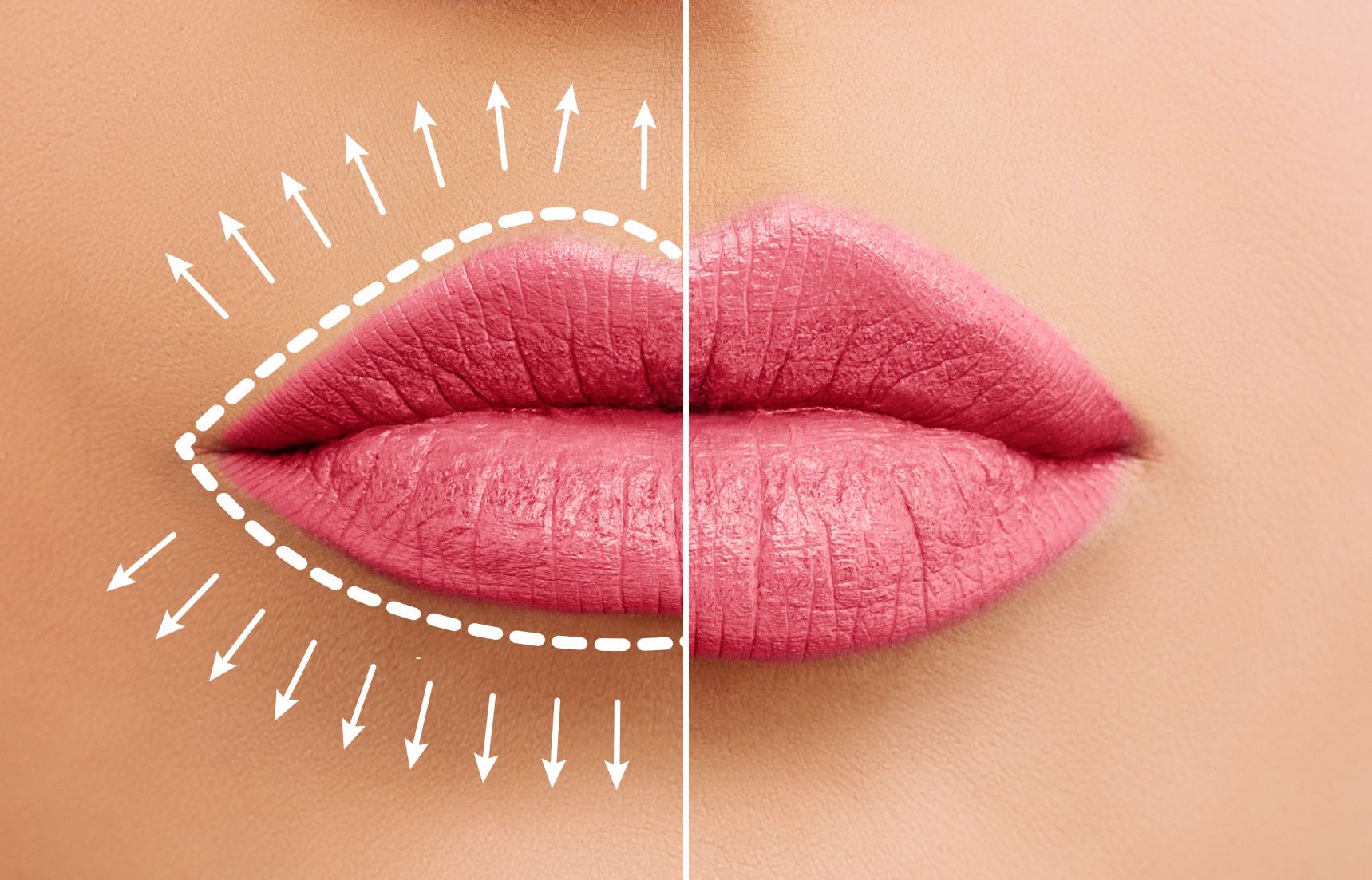 Lippenvergrößerung, Lippenvolumen Lippenvergrößerung, Lippenvolumen