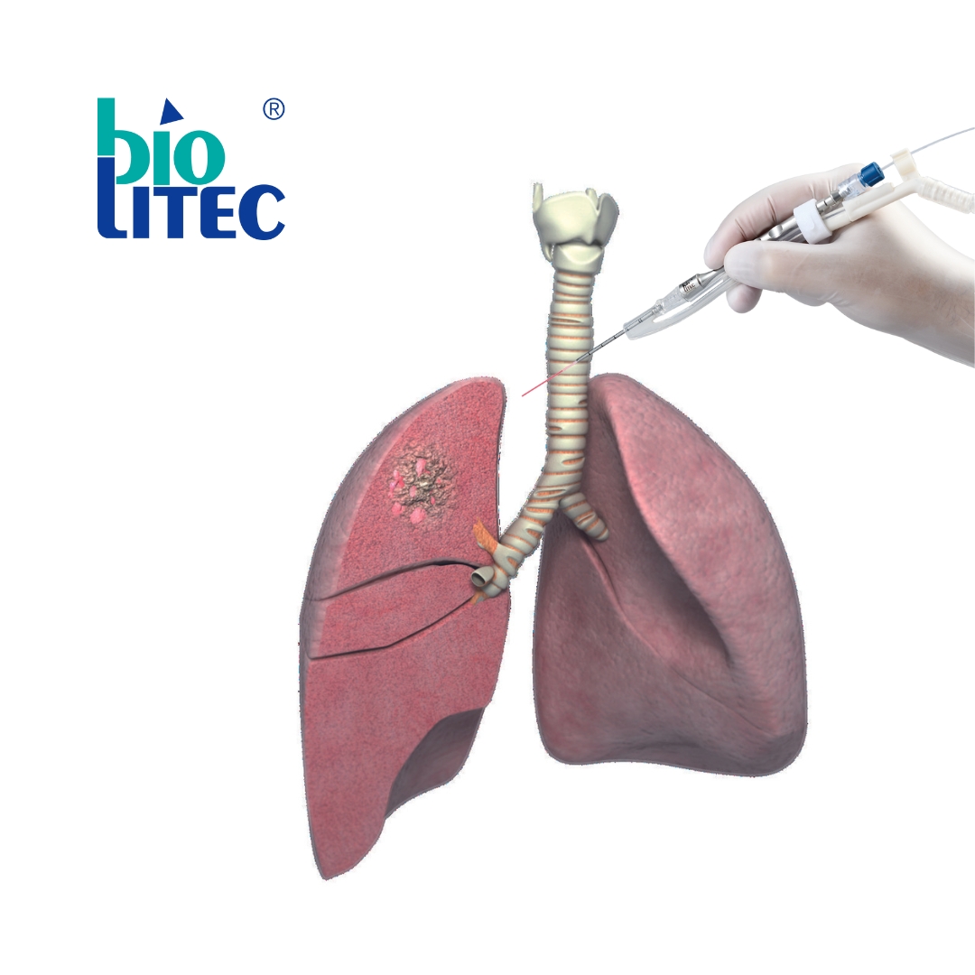 biolitec High Performance Laser-Faser mit Handstück für die Thorax-Chirurgie (Bildquelle:©biolitec®) biolitec High Performance Laser-Faser mit Handstück für die Thorax-Chirurgie (Bildquelle:©biolitec®)