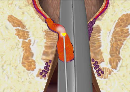 Laserfaser LHP der biolitec während der Bestrahlung einer Hämorrhoide von innen (Bildquelle:©biolitec®) Laserfaser LHP der biolitec während der Bestrahlung einer Hämorrhoide von innen (Bildquelle:©biolitec®)