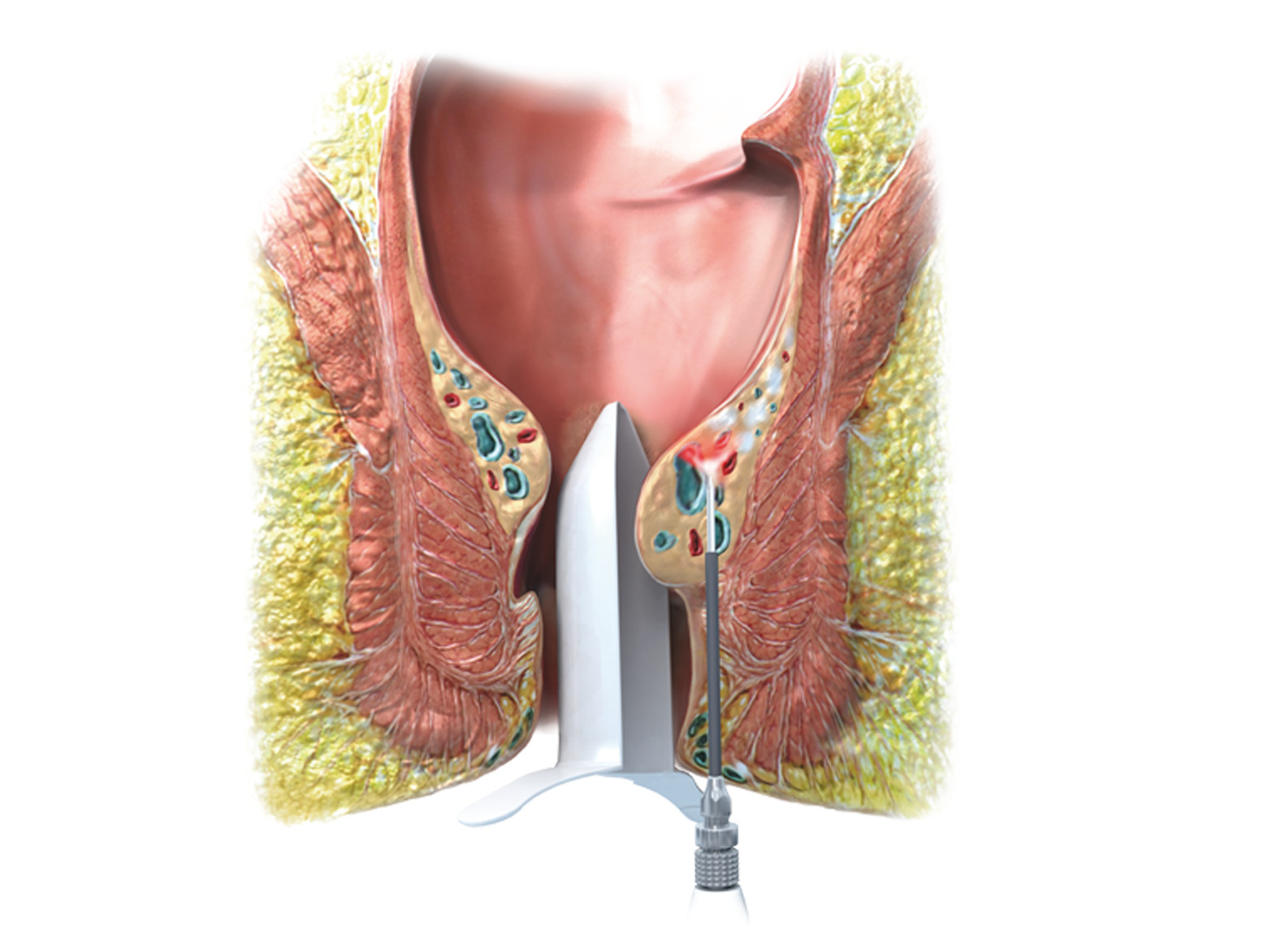 LHP®Laserfaser von biolitec®(Bildquelle: @ biolitec®)