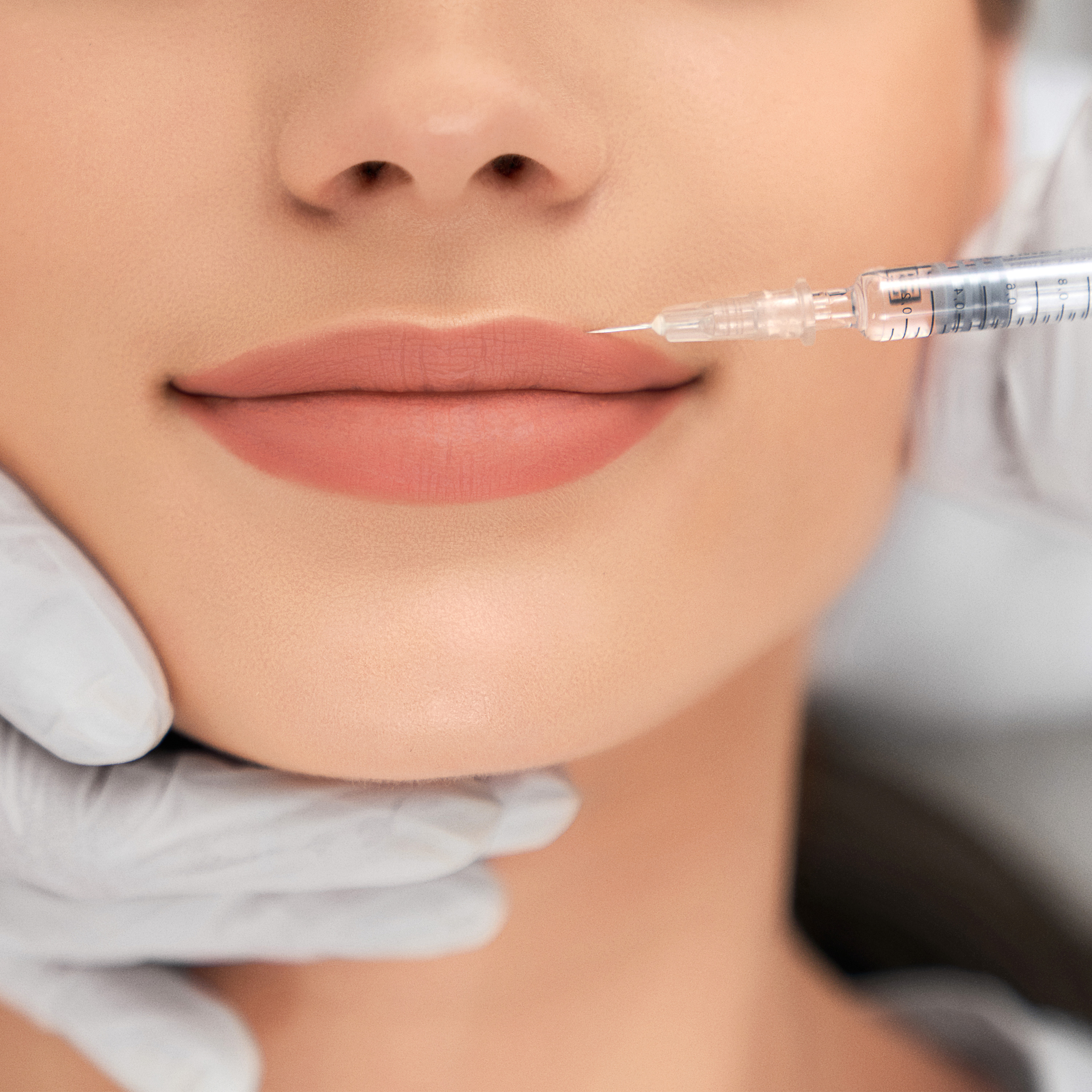 Lippenunterspritzung mit Hyaluronsäure-Gel bei Heaven Spa in Dachau Lippenunterspritzung mit Hyaluronsäure-Gel bei Heaven Spa in Dachau