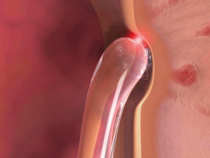 Prostata-Behandlung im Kontakt-Modus mit der TWISTER-Laserfaser der biolitec (Bildquelle:©biolitec®) Prostata-Behandlung im Kontakt-Modus mit der TWISTER-Laserfaser der biolitec (Bildquelle:©biolitec®)