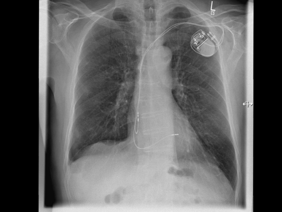 Eine minimalinvasive Herzklappenintervention kann besonders für Risikopatienten infrage kommen. (Die Bildrechte liegen bei dem Verfasser der Mitteilung.)