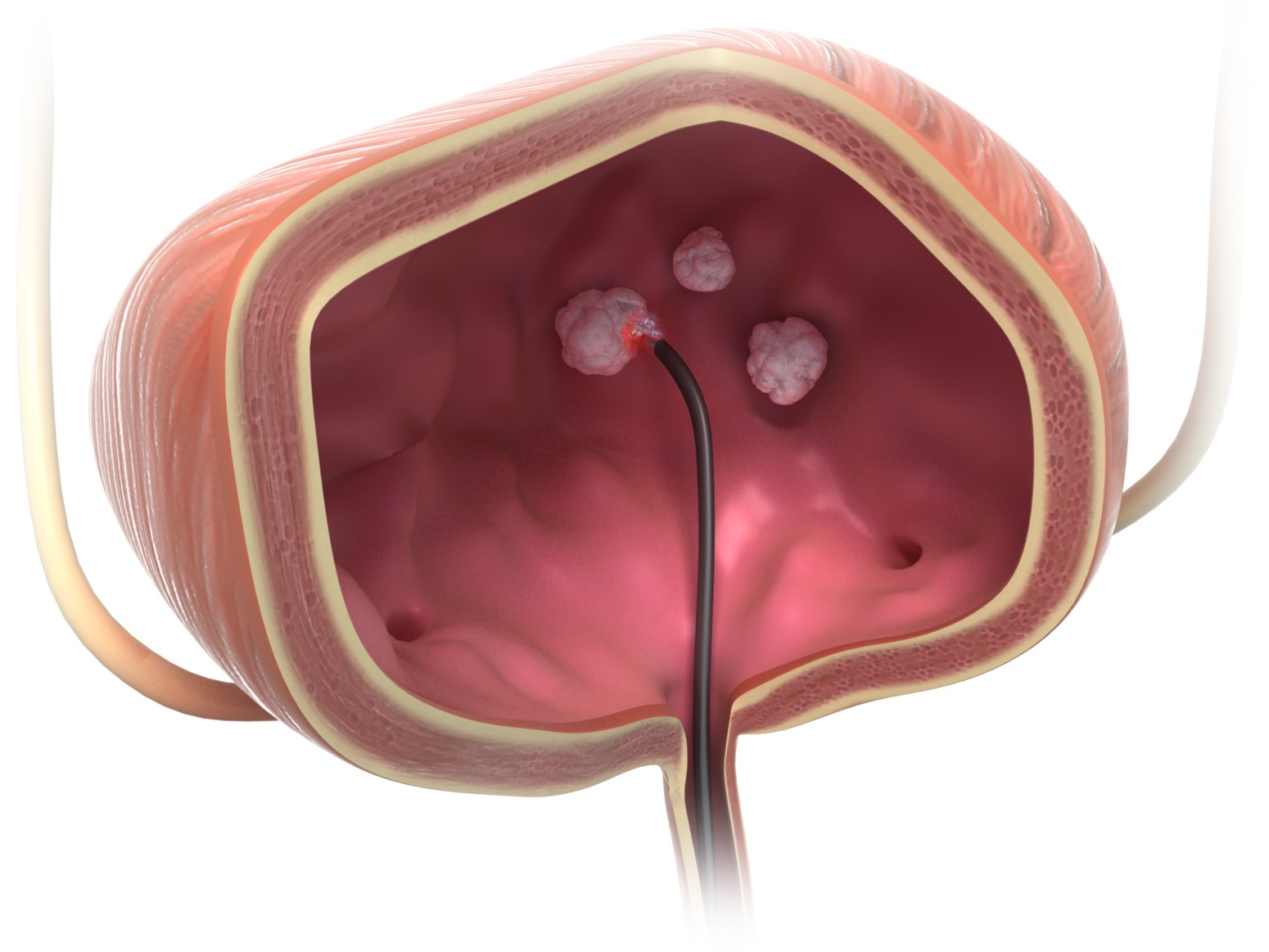 Blasentumor-Entfernung mit TULA-Lasertherapie von biolitec (Bildquelle: @ biolitec) Blasentumor-Entfernung mit TULA-Lasertherapie von biolitec (Bildquelle: @ biolitec)