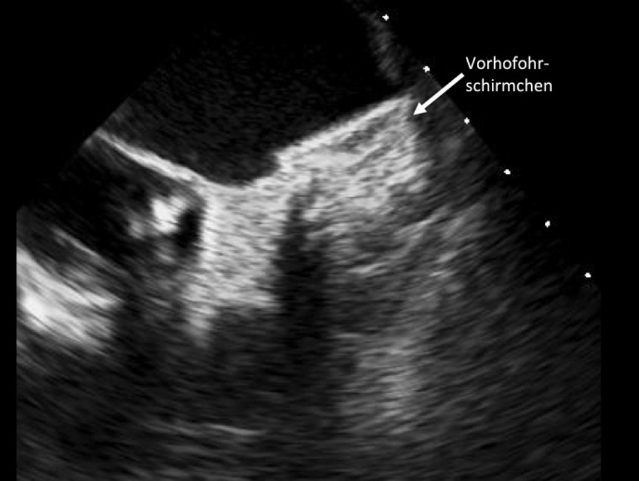 Es wird diskutiert, ob eine Katheterablation bei Vorhofflimmern als Ersttherapie geeignet ist. (Die Bildrechte liegen bei dem Verfasser der Mitteilung.)