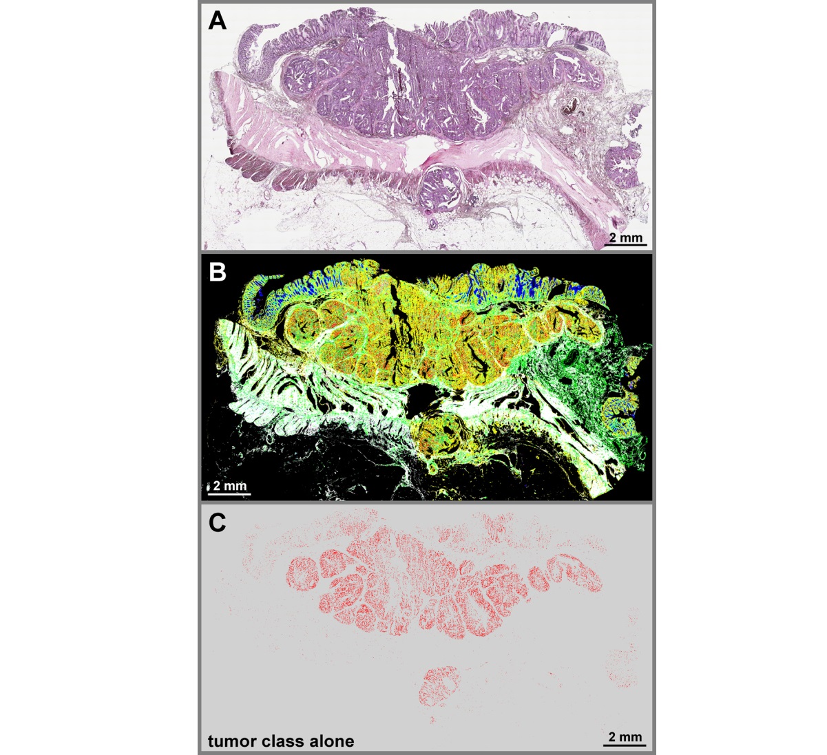 Dünnschnittbilder Darmkrebs - H&E-Färbung (A) und markierungsfreie Indexfarbbilder (B/C). (Bildquelle: (Bildnachweis: Klaus Gerwert et.al. SCIENTIFIC REP) Dünnschnittbilder Darmkrebs - H&E-Färbung (A) und markierungsfreie Indexfarbbilder (B/C). (Bildquelle: (Bildnachweis: Klaus Gerwert et.al. SCIENTIFIC REP)