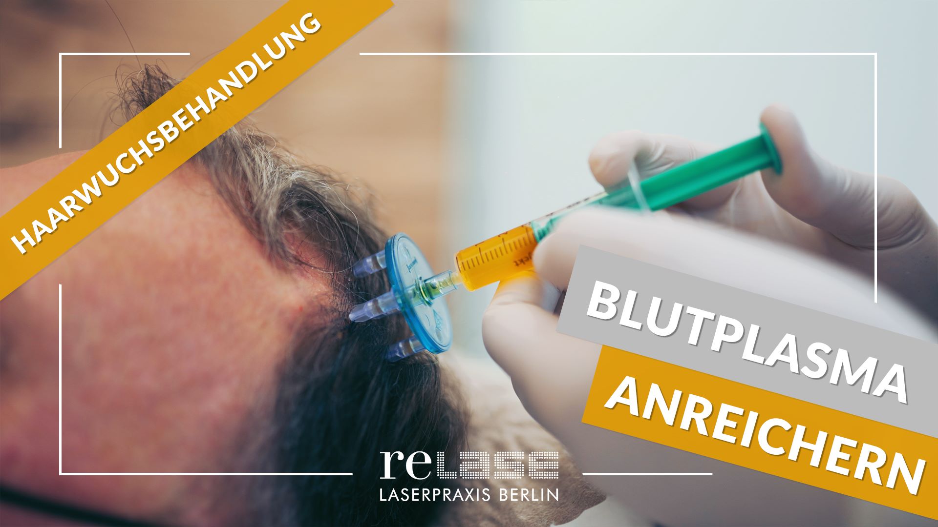 PRP Behandlung bei Haarausfall (Die Bildrechte liegen bei dem Verfasser der Mitteilung.)