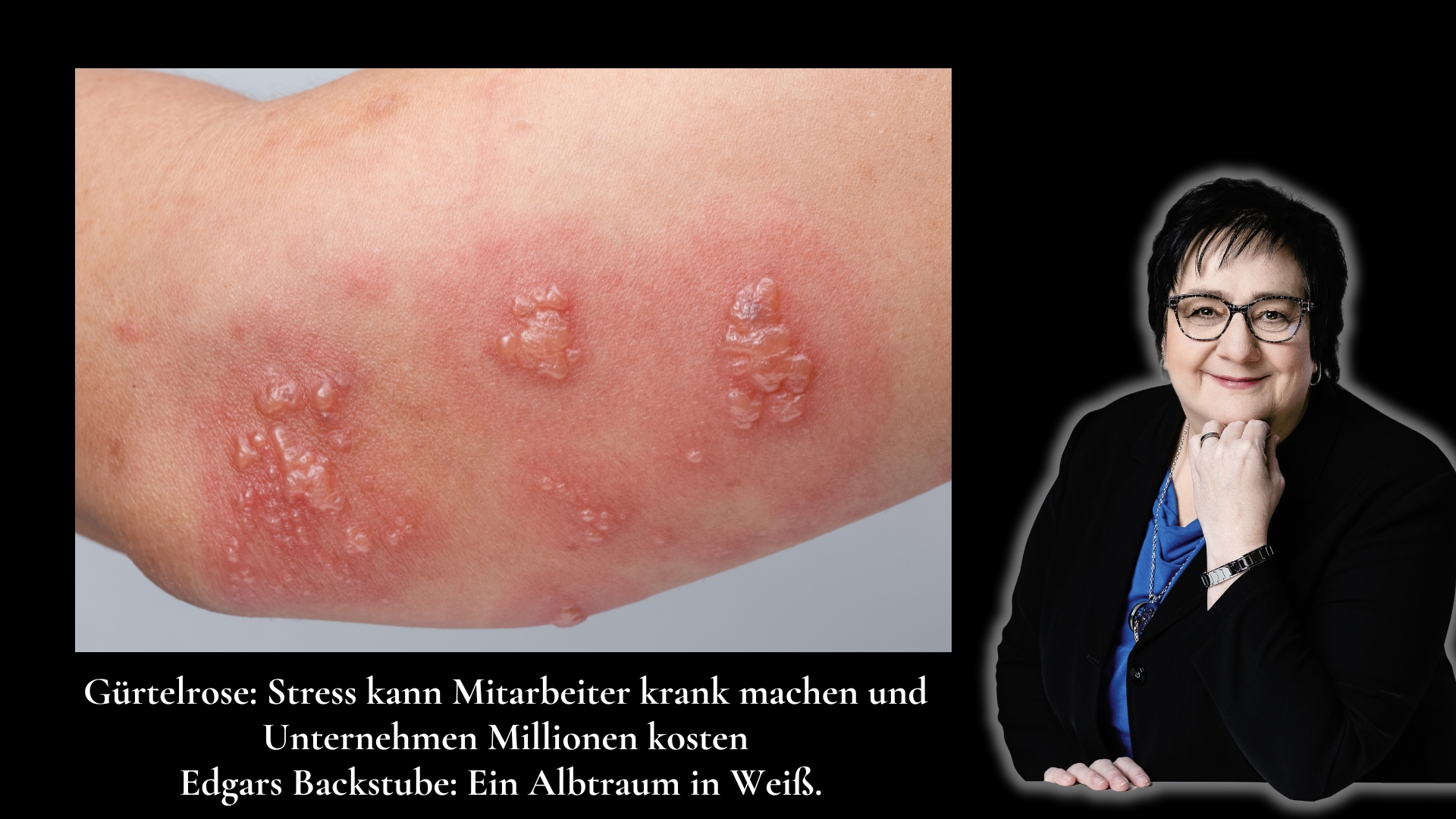 Gürtelrose& Stress, eine teure Kombi, für Unternehmen Helene Kollross (Die Bildrechte liegen bei dem Verfasser der Mitteilung.) Gürtelrose& Stress, eine teure Kombi, für Unternehmen Helene Kollross (Die Bildrechte liegen bei dem Verfasser der Mitteilung.)