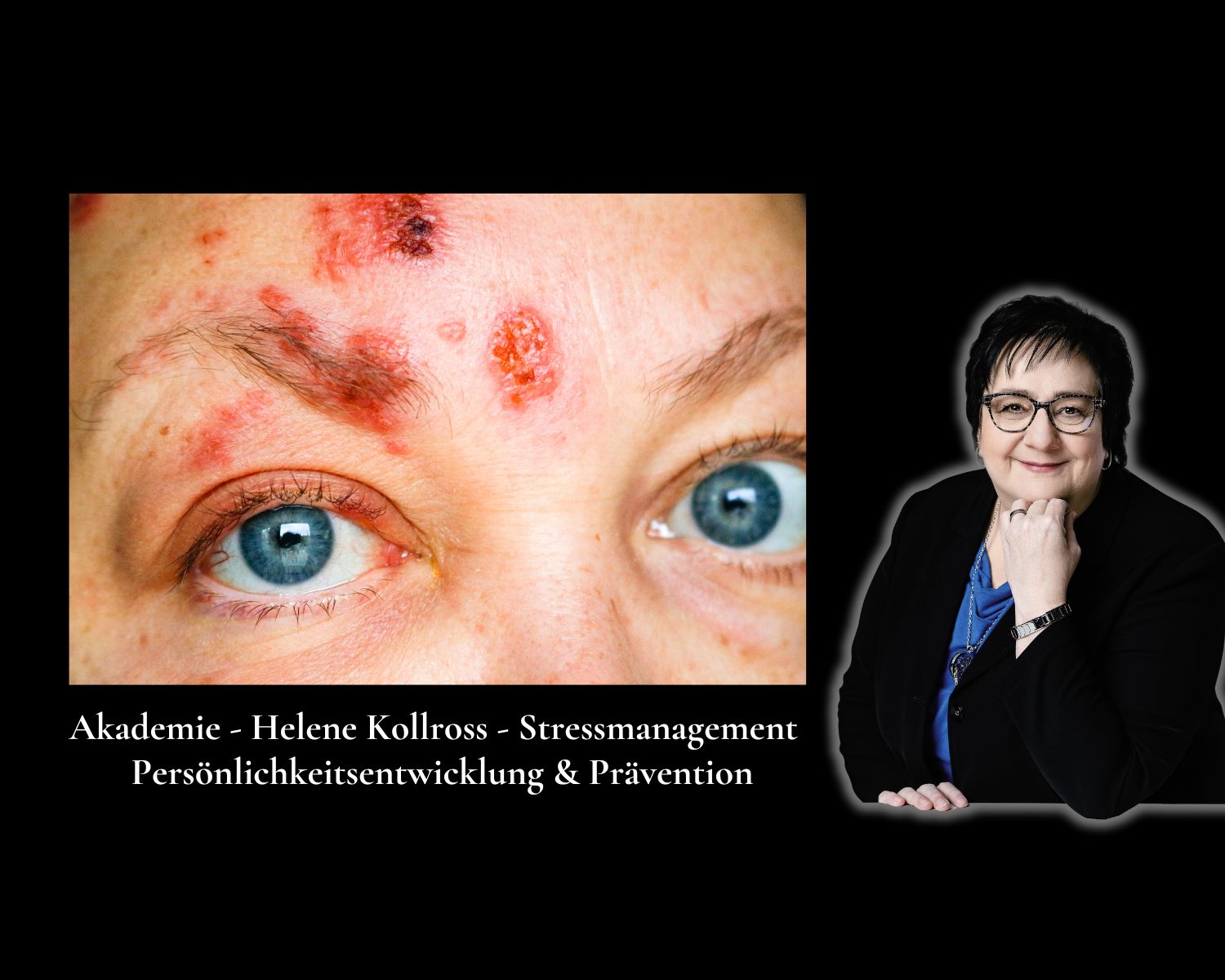 Gürtelrose besiegen: Stress reduzieren (Die Bildrechte liegen bei dem Verfasser der Mitteilung.) Gürtelrose besiegen: Stress reduzieren (Die Bildrechte liegen bei dem Verfasser der Mitteilung.)