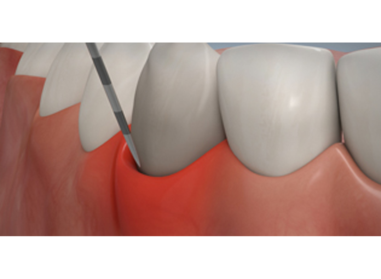 Praodontitis und Parodontose Behandlung Praodontitis und Parodontose Behandlung