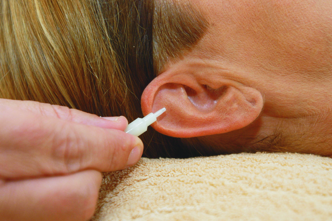 Bei der Implantat-Akupunktur setzen dieÄrzte Dauerimplantate an ausgewählte Ohrpunkte. (Bildquelle: Copyright: Dr. Wlasak)