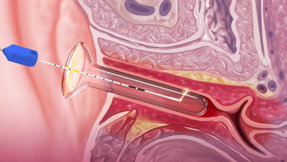 Leonardo Dual Diodenlaser-Behandlung bei urogenitalem Menopausensyndrom (Bildquelle: @biolitec) Leonardo Dual Diodenlaser-Behandlung bei urogenitalem Menopausensyndrom (Bildquelle: @biolitec)