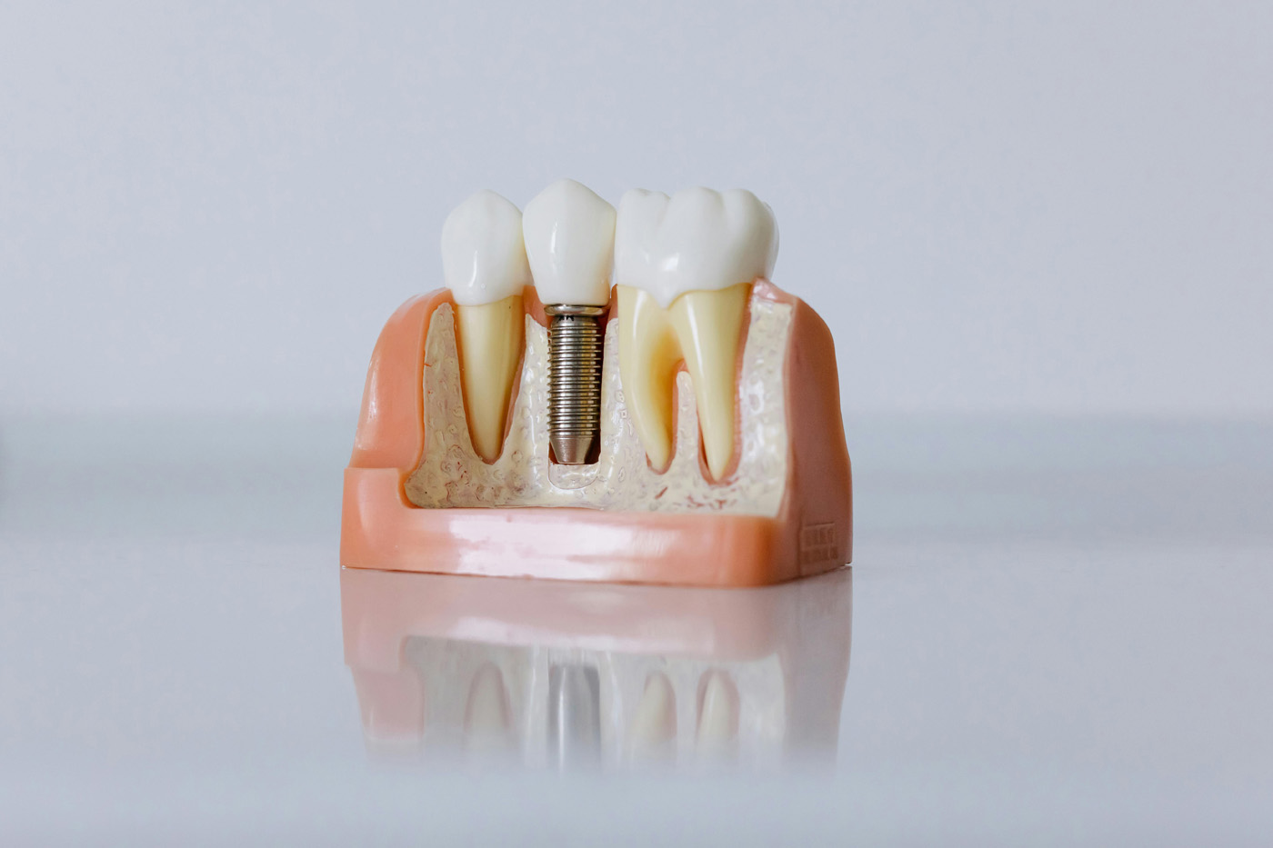 Keramik Implantat