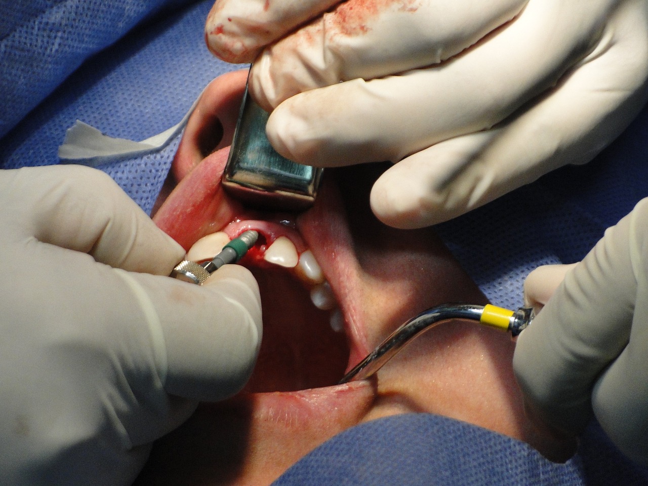 unterschiedliche Zahn Implantat Arten