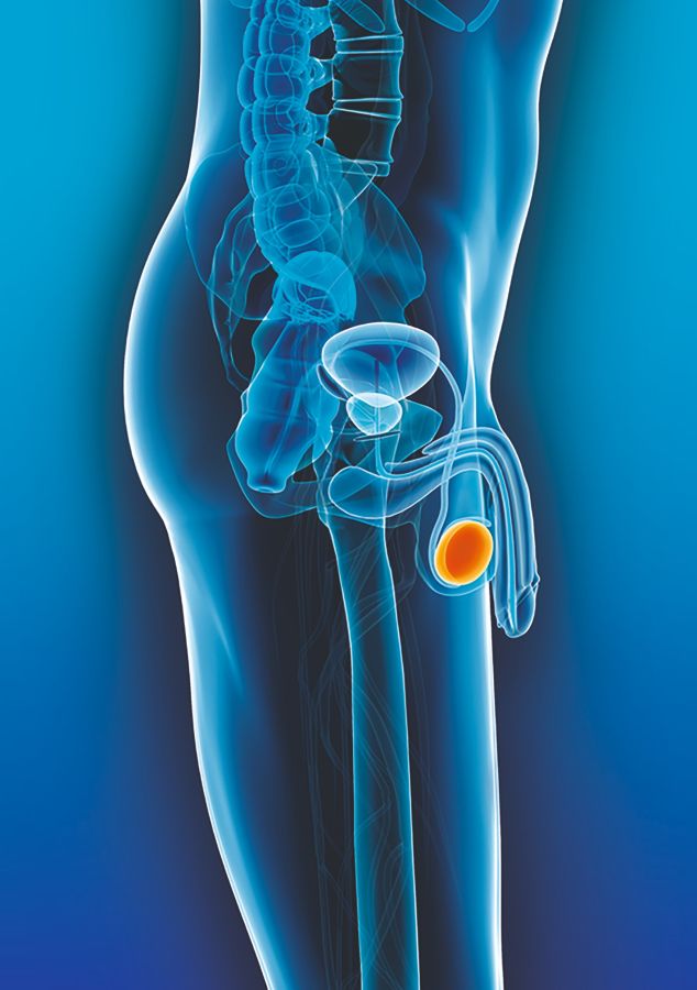Tumor am Hoden (© Deutsche Krebshilfe) Tumor am Hoden (© Deutsche Krebshilfe)