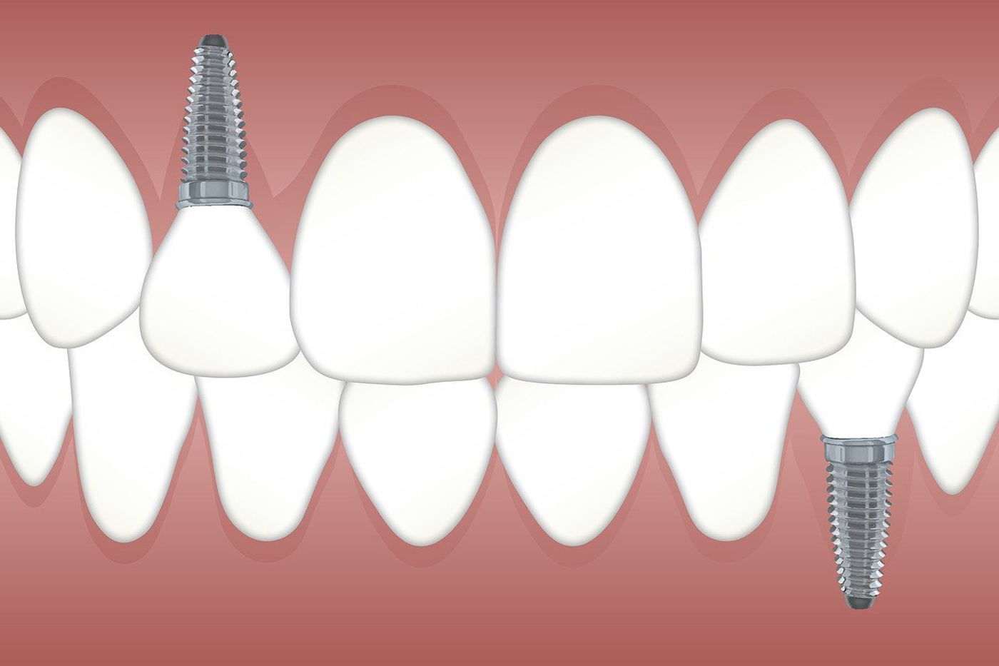 Guided Surgery in der modernen Implantologie Guided Surgery in der modernen Implantologie