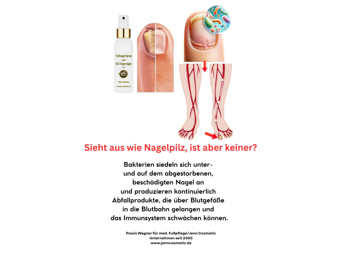 Sieht aus wie Nagelpilz, ist aber keiner Sieht aus wie Nagelpilz, ist aber keiner