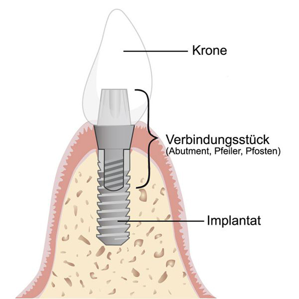 Schwerpunktpraxis für Implantationen Prof. Dhom