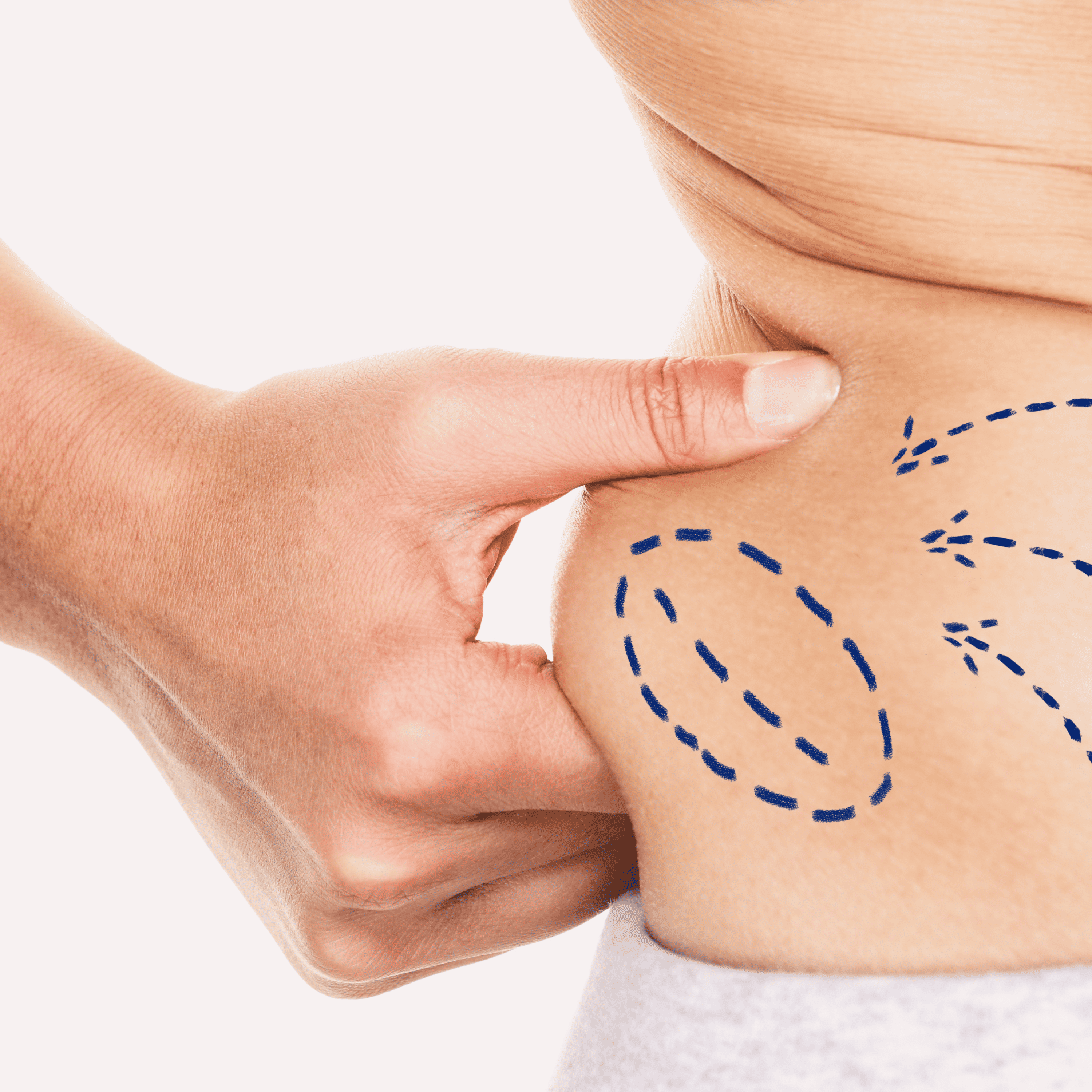 Fettabsaugung Hamburg